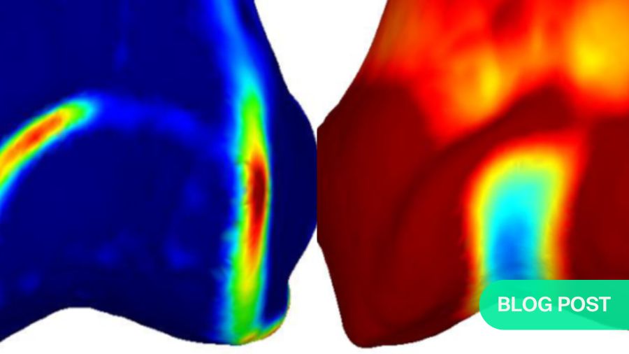AO Sports Blog - Patellofemoral syndrome