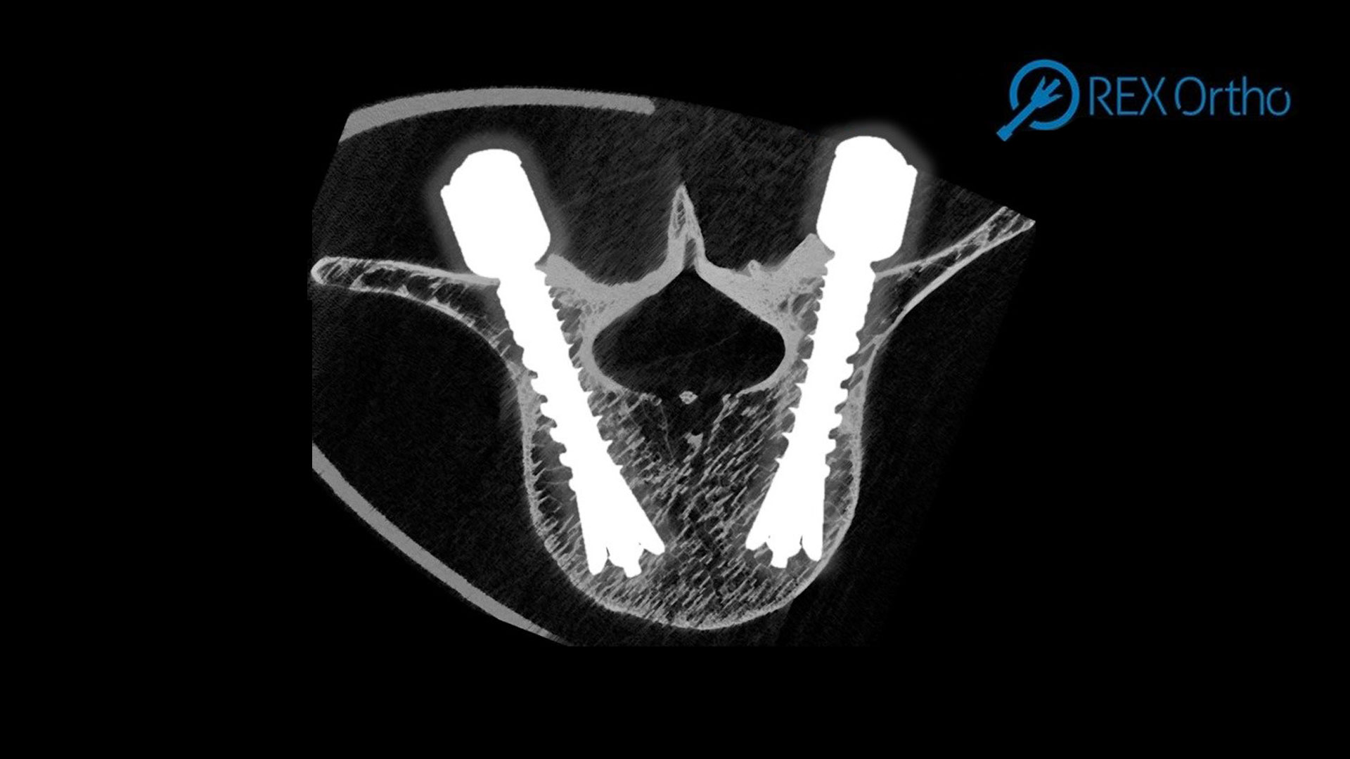 AO innovation resources support development of new spinal screw